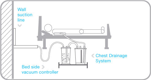 Bedside Vacuum Controller diagram